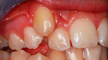 Espansione rapida del palato: terapia del deficit trasversale scheletrico del mascellare superiore