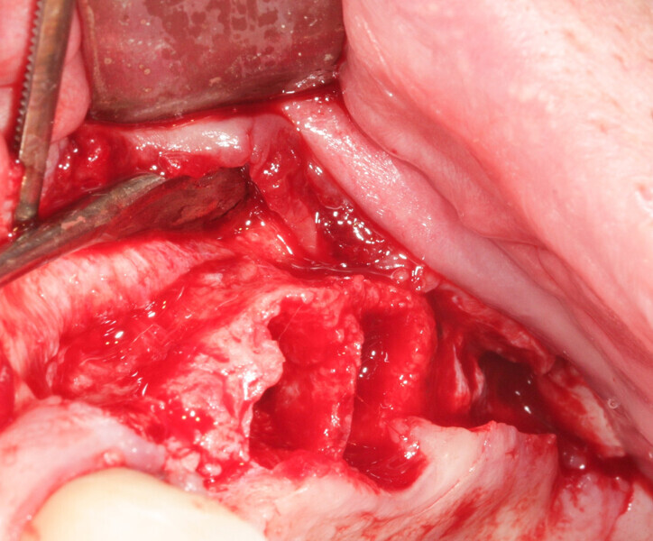 Fig. 11: Full-thickness flap elevation and extraction of teeth #23 and 24.