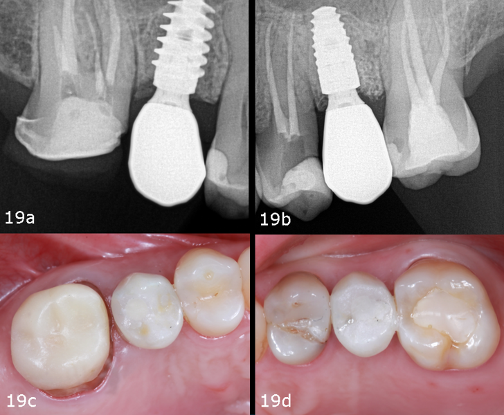 Figs. 19a–d: Radiographic (a & b) and occlusal views showing stable soft- and hard-tissue levels at the one-year follow-up (c & d).