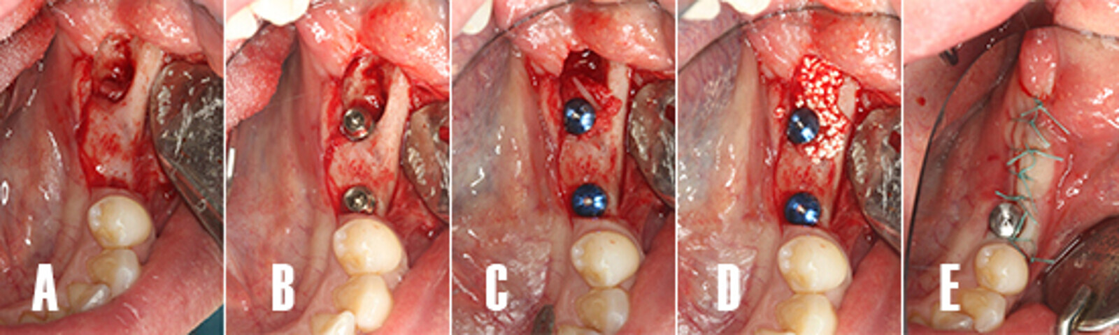 Figura 12. CirugÃ­a de implantes. A) Despegamiento de colgajo a espesor total. B) Tras la preparaciÃ³n del lecho implantario se instalan dos implantes dentales en posiciÃ³n 3.5 y 3.7. C) ColocaciÃ³n de tapas de cierre. D) Se coloca un injerto particulado aloplÃ¡stico para regenerar el defecto Ã³seo distal del implante en posiciÃ³n 3.7. E) Cierre del colgajo con puntos interrumpidos con seda no reabsorbible.