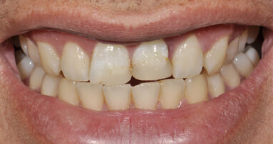 Biomimética con un sistema de color inteligente