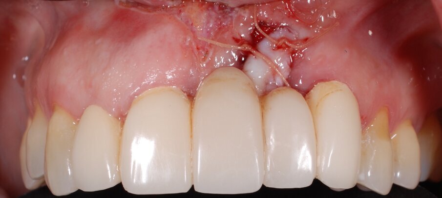 Fig. 7 - Applicazione del provvisorio dopo preparazione protesica del 2.3 e frenulectomia laser.