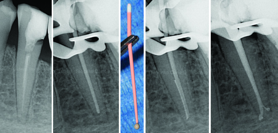Figg. 5 - A, rx preoperatoria 3.5 cura incongrua, B dopo strumentazione prova cono ad 1 mm, C cono master diametro in punta 45 con cemento, D rx dopo aver condensato il cono master mediante spreader in NiTi, E rx dopo otturazione mediante guttaperca plasticizzata.