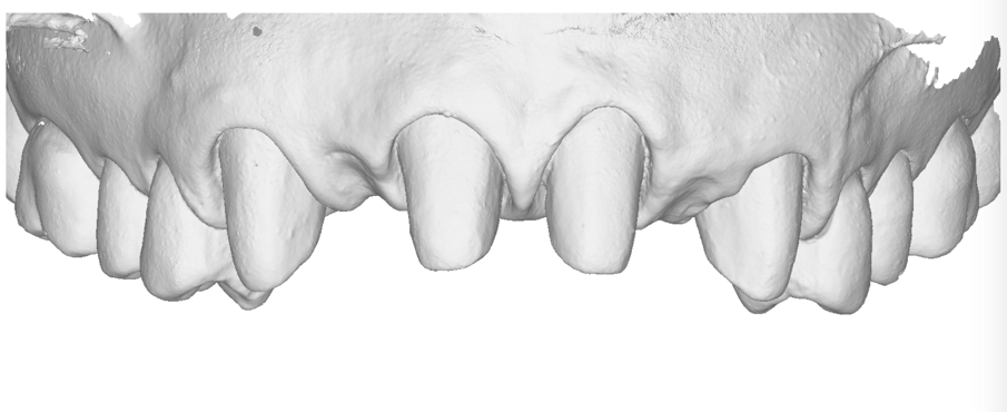Fig. 19_Collasso dei tessuti nella scansione finale in visione frontale.