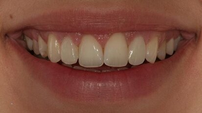 Conservative smile enhancement: Direct composite resin restoration of conoid lateral incisors