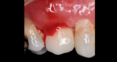 El enemigo invisible en la periimplantitis