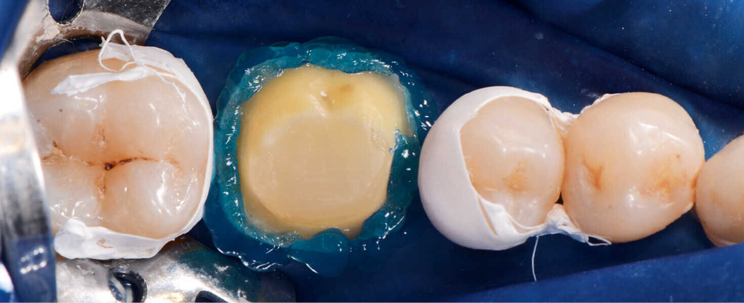 Fig. 6. Grabado de esmalte antes de la aplicación del adhesivo.