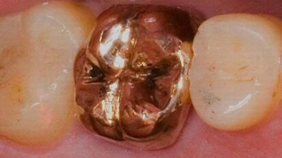 Vraag naar dentaal goud daalt sterk