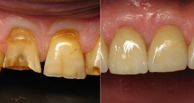 Tenet: Time inversion applied to dentistry