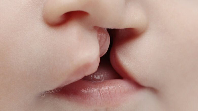 Researchers find genetic mechanism that triggers cleft lip and palate