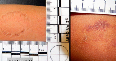 L’importanza dell’odontologo forense nell’analisi dei “bitemarks” per riconoscere le fattispecie di reato associate a maltrattamenti e/o abusi