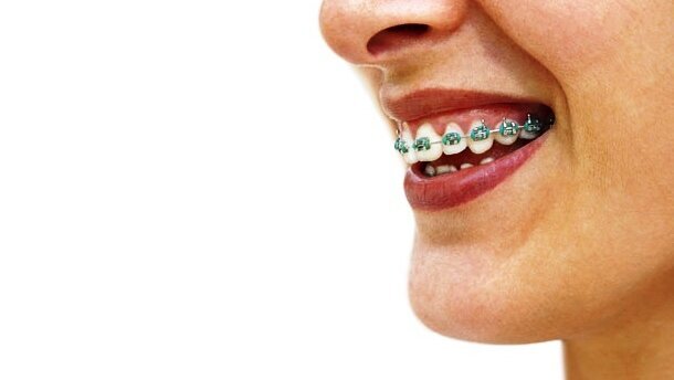 Kosmetyczna ortodoncja?