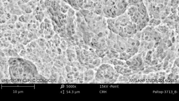Impianti dentali privi di impurità sono essenziali per il successo clinico