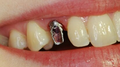 Wpływ czynników estetycznych na wybór metody rehabilitacji implantoprotetycznej