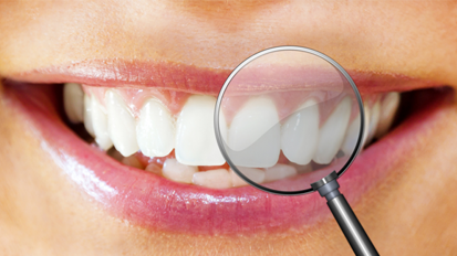 Bleaching mit Aktivkohle als neuer Beauty-Trend