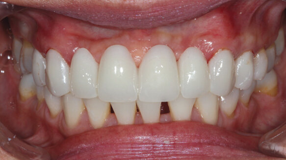 Utilizing a digital workflow for provisionalization