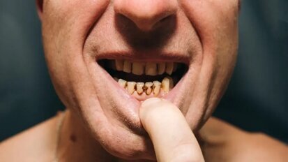 Cena je hlavním faktorem neuspokojených potřeb v oblasti zubní péče v zemích EU