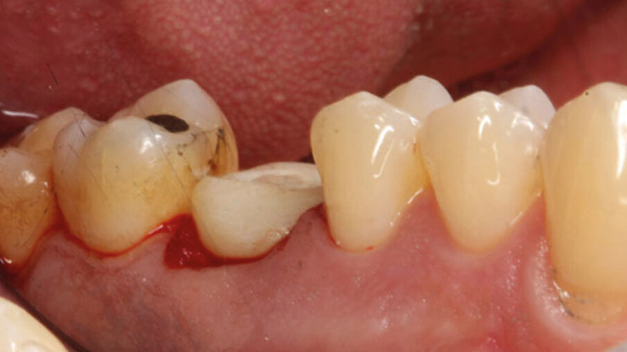 Fig. 6 - Vite customizzata in situ con interposta la matrice in collagene Fibro-Gide, precedentemente imbibita di gel Regenfast.