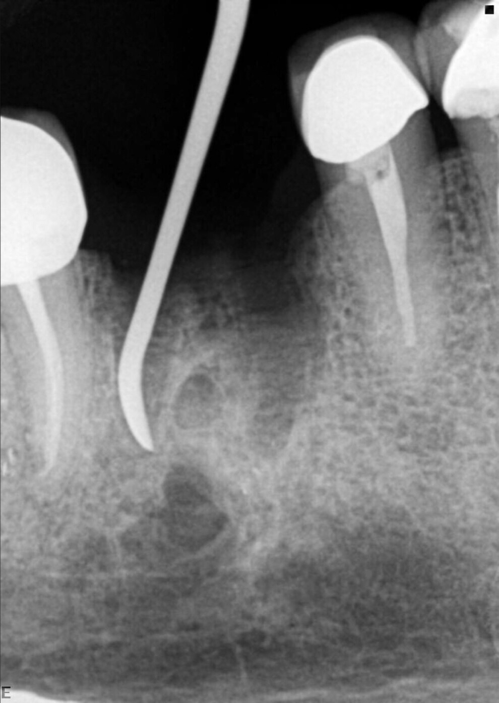 Fig. 15: After extraction of the molar, checking for any connection with the lesion.