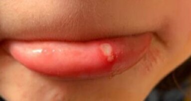 Brzo olakšanje kod afti te lezija i oštećenja usne sluznice uz Curasept Afterapid