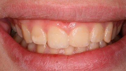 Riabilitazione estetica con resine composite in caso di severa Molar Incisor Hypoplasia: case report