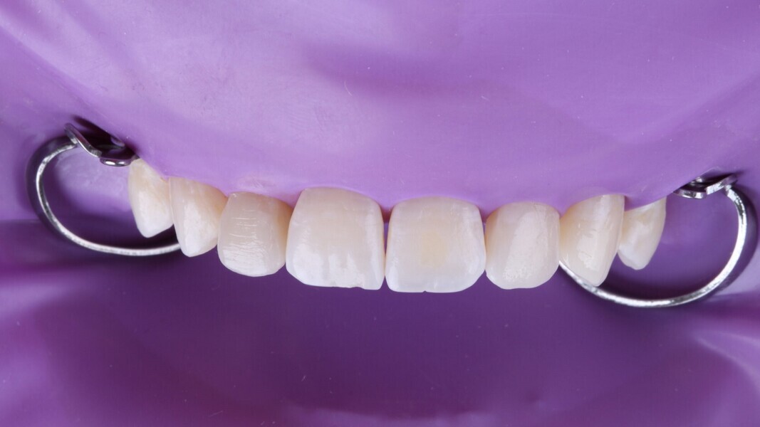 Fig. 13: Alle restauraties voltooid vóór het polijsten.