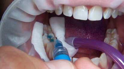 La videocamera intraorale, un valido supporto nella pratica clinica