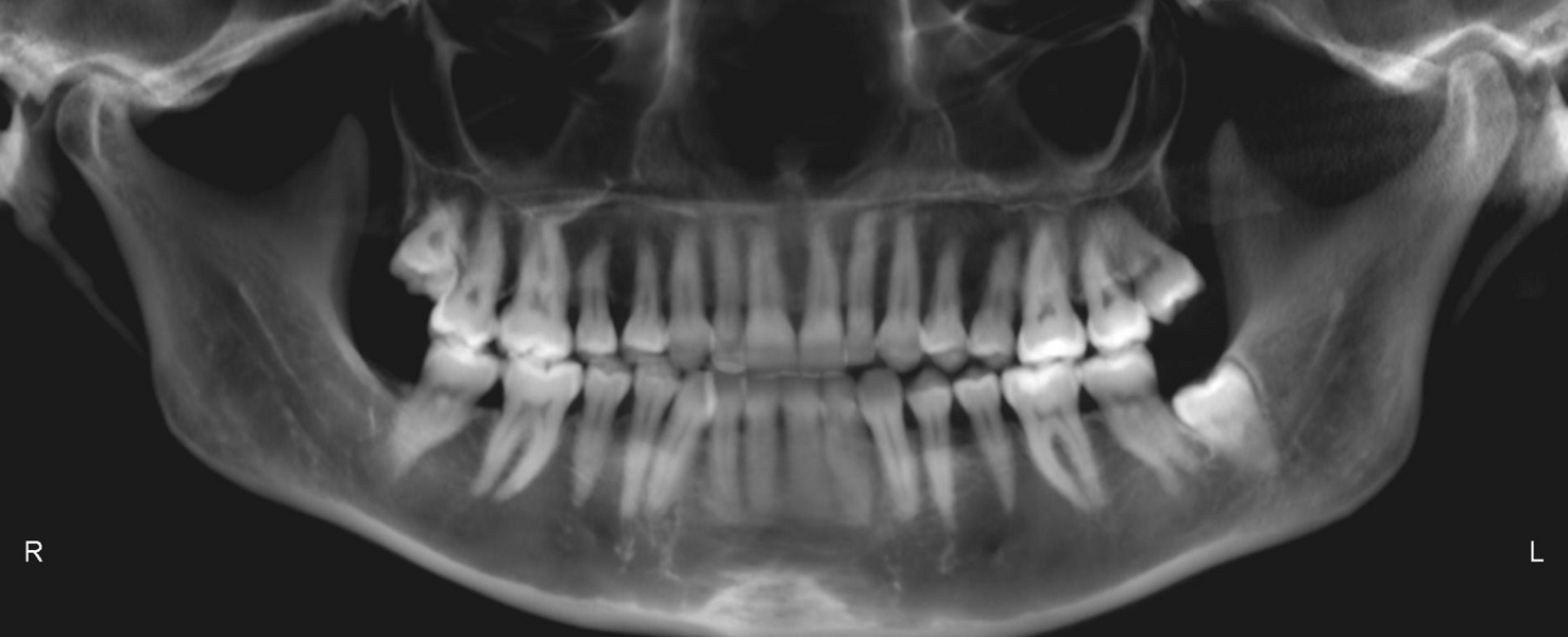 Fig. 33: Pretreatment dental panoramic tomogram.