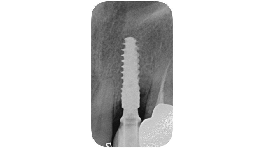 Fig. 5_Rx periapicale post-impianto.