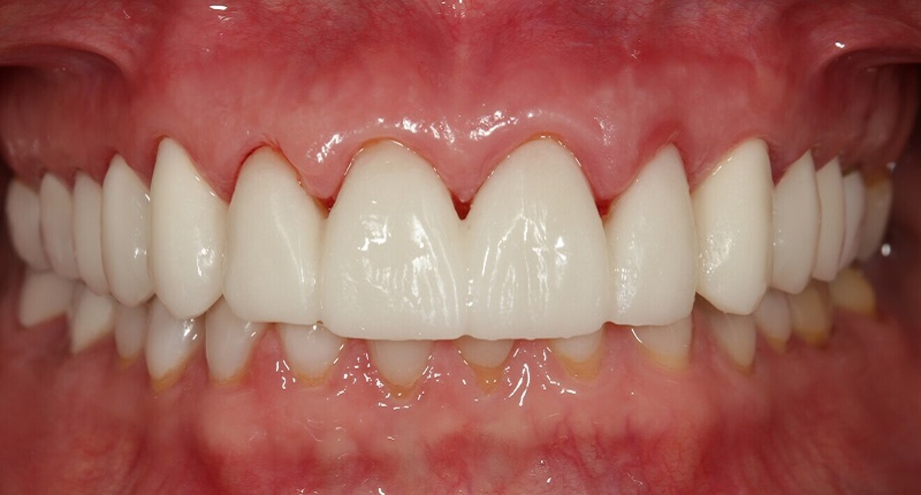 Fig. 15: Third PMMA prototype in place.