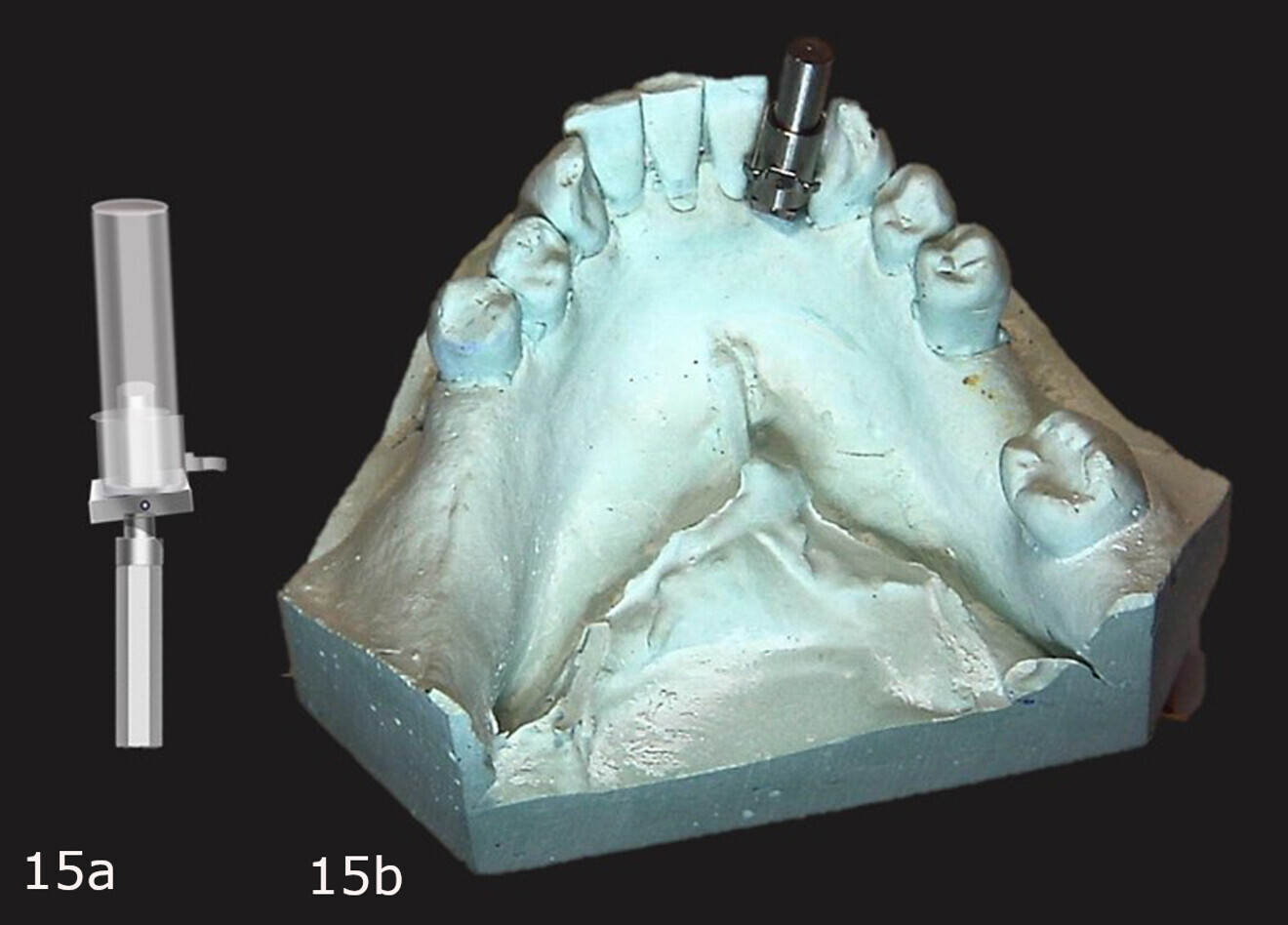 Figs. 15a & b: Upper removable part placed over the modied offset guide post on the cast and the guide sleeve placed over it with the cleat to the lingual aspect (a), all on the cast (b).