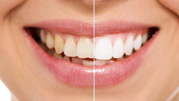 Man fined £11,500 for providing illegal tooth whitening and training