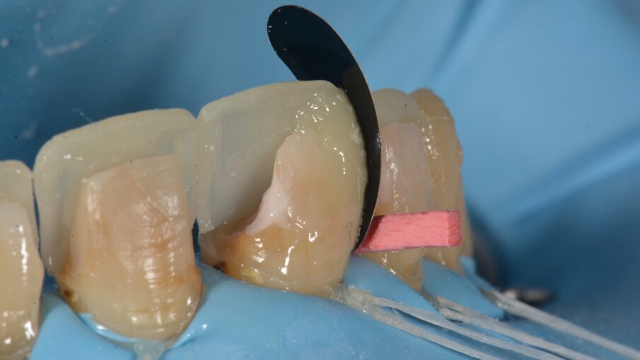 Om de interdentale ruimtes op te bouwen maken we gebruik van een rechtopstaande niervormige matrix. Door de convexiteit van de matrix naar buccaal te plaatsen hebben we al een referentie om het buccale vlak te modelleren. Het wit-roze materiaal dicht bij de pulpa is de 3M Filtek Universal Restorave Pink Opaquer, die het verkleurde dentine zal maskeren om zo een uniformere kleur te kunnen verkrijgen.