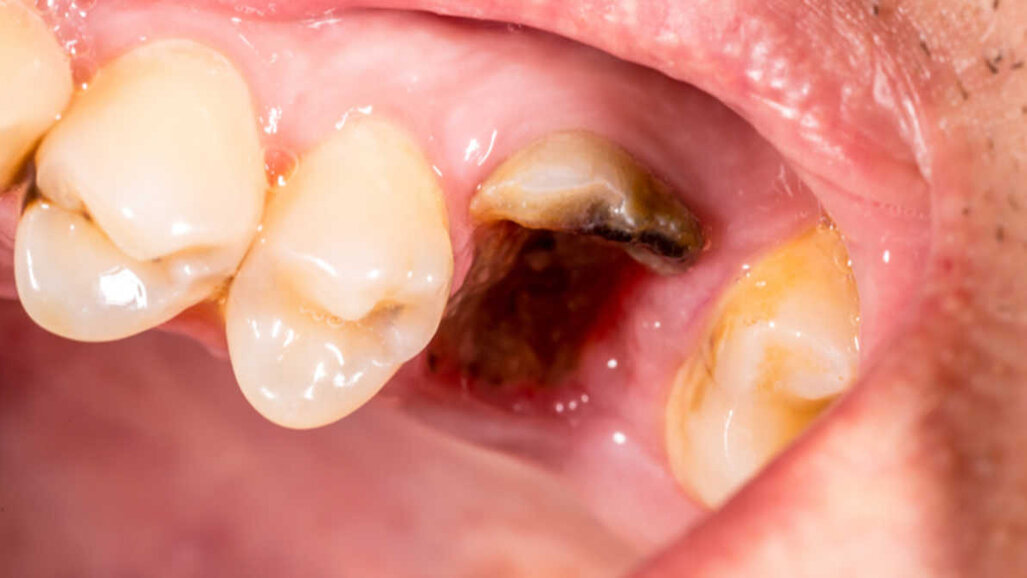 Saúde bucal deficiente associada a maior risco de câncer de fígado
