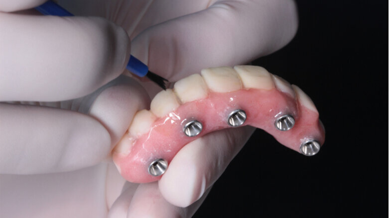 Review recommends tooth- and implant-supported fixed dental prostheses
