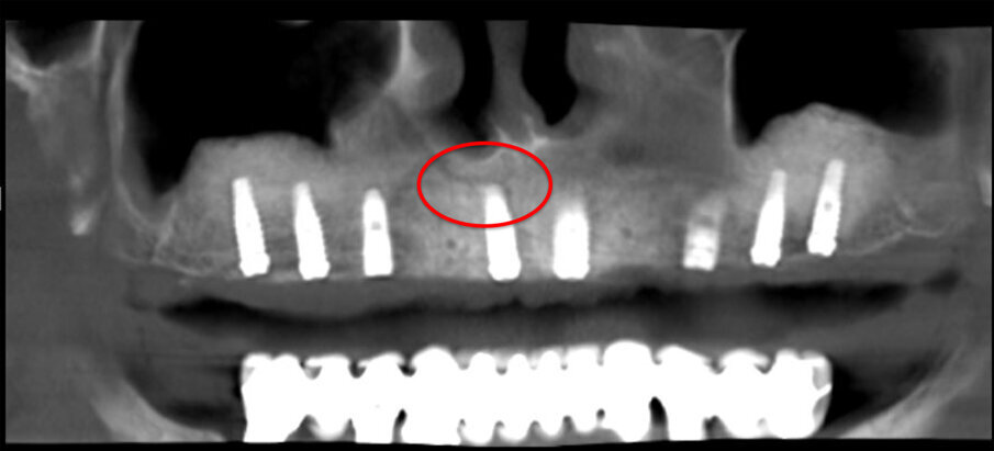Fig. 5 - Panorex Postoperatoria con CS in evidenza.