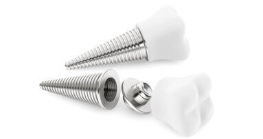 Mikrogewinde an Implantaten begünstigen Osseointegration