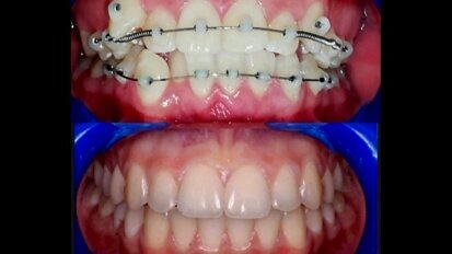 Ortodoncia fija sin brackets con la técnica SLIDE OD