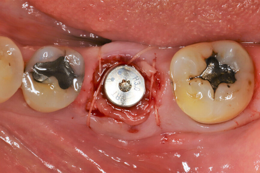 Fig. 16: Sutures to stabilise the biomaterials in place.