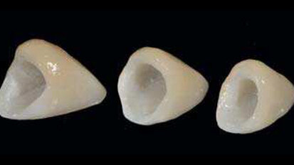 Entre BOPT et BTA : Une étude de cas sur le remodelage du contour gingival de restaurations dento-portées au moyen de couronnes provisoires en résine.