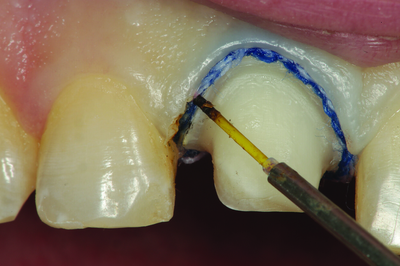 Fig. 12: Using a super-pulsed diode laser to remove the excess tissue incisal to the top cord.