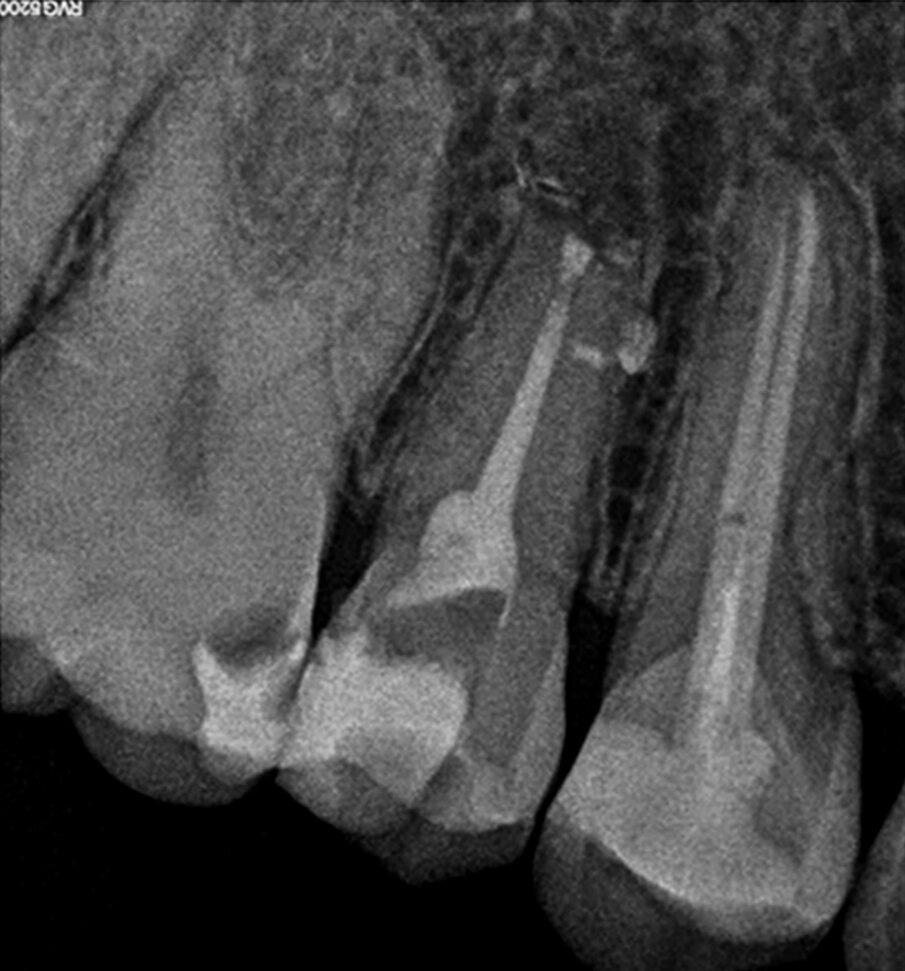 Fig. 1k: Immediate post-op radiograph of tooth #36.