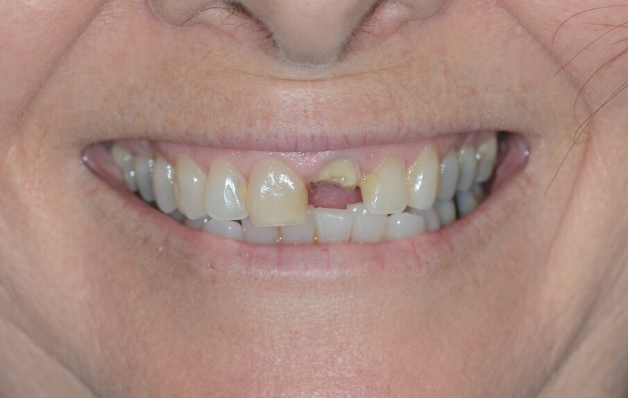 Fig. 1_Situazione iniziale, visione extra-orale.