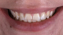 From trauma to harmony: A minimally invasive approach to anterior aesthetics