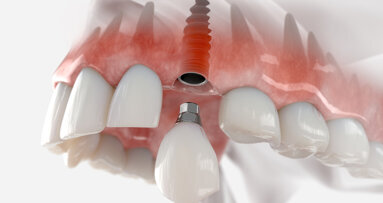 Researchers in Australia seek to improve dental implant outcomes
