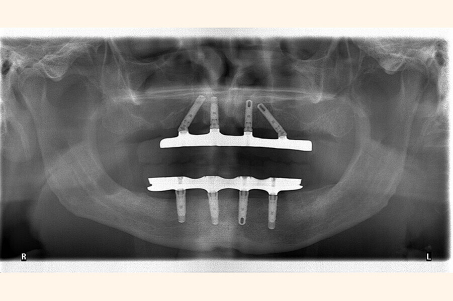 Fig. 14. Rx Control y Prótesis híbrida inmediata con 5 años de evolución.