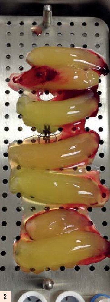 figure 2 : Caillot d’A-PRF placé dans la PRF Box avant d’être pressé. La PRF BOX permet la préparation de membranes homogènes compatibles avec une utilisation en clinique.