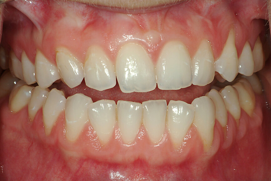Fig. 15: Occlusion with the mandible in centric relation and a significant open bite.