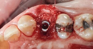 Studio Carosi-Lorenzi: nuove evidenze sulla stabilità degli impianti TLX Straumann nel primo anno di guarigione