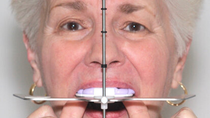 Digitální technika přenosu obličejovým obloukem pomocí dentofaciálního analyzátoru